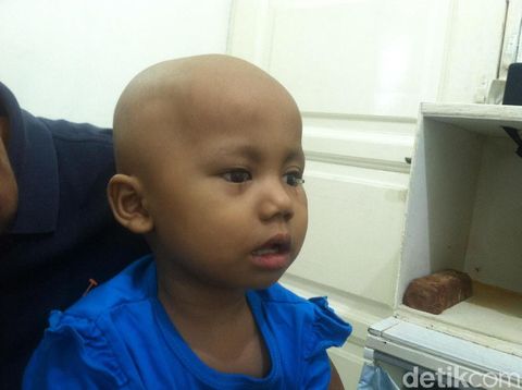 Salah satu pasien anak yang mendapatkan mata palsu.