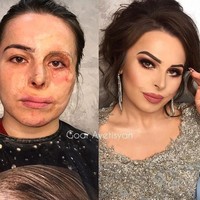 Jamilya mengalami luka bakar saat usianya 2,5 tahun. Lihat bagaimana dia berubah menjadi wanita berbeda hanya dengan makeup. Foto: Instagram Goar Avetisyan