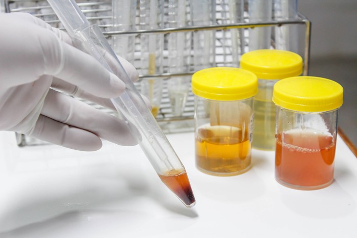 Reagent Strip for Urinalysis, Routine Urinalysis, urine test analysis in laboratory.