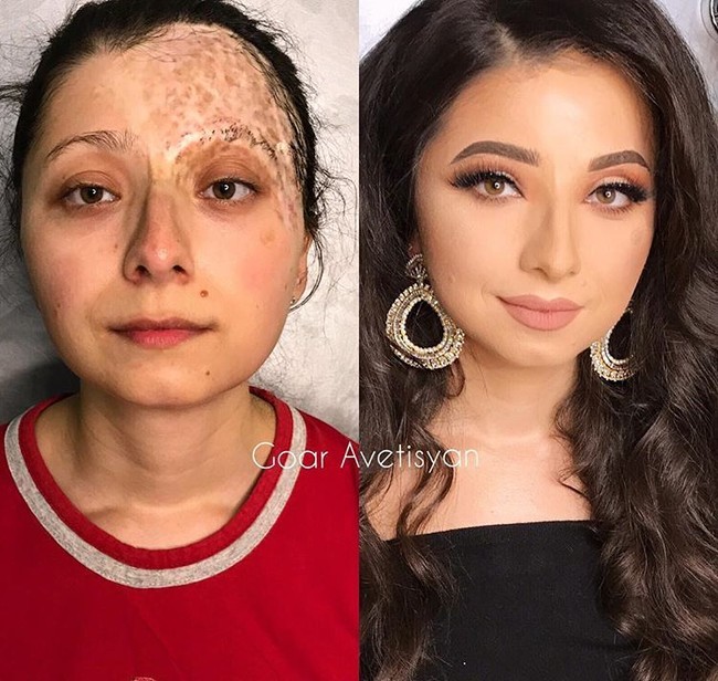 Lilya sudah melalui dua kali operasi cangkok kulit. Bekas luka di wajahnya menjadi tidak terlihat berkat makeup. Foto: Instagram Goar Avetisyan
