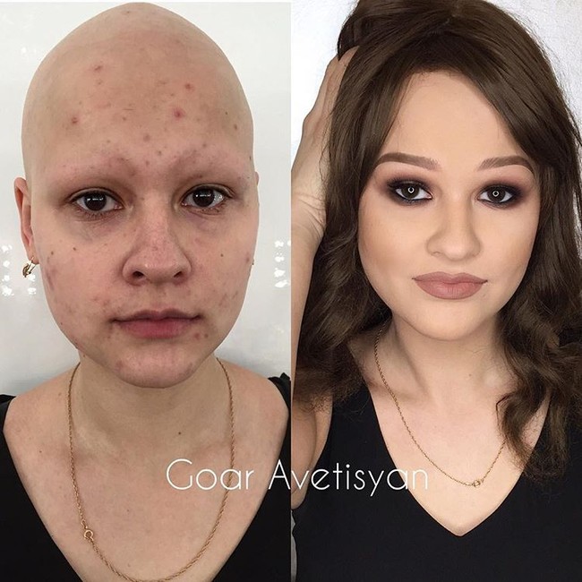 Ini adalah Ann yang menderita alopecia (kerontokan total pada rambut di seluruh tubuh). Ann menjadi sangat cantik setelah dirias oleh Goar. Foto: Instagram Goar Avetisyan