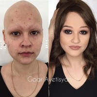 Ini adalah Ann yang menderita alopecia (kerontokan total pada rambut di seluruh tubuh). Ann menjadi sangat cantik setelah dirias oleh Goar. Foto: Instagram Goar Avetisyan