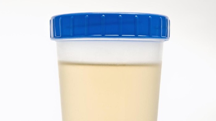 Ciri Warna Urine yang Sehat dan Penyebab Perubahan Warnanya