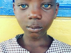Foto: Mata Biru Menyala Indah Para Penyandang Sindrom Waardenburg