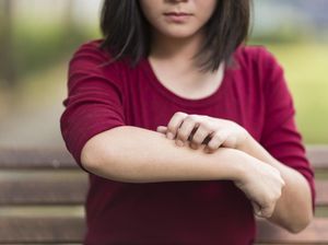 Seperti Vampir, Gadis Ini Alergi Terhadap Matahari