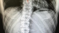 Padahal ia memiliki tulang punggung yang bengkok, atau dikenal sebagai scoliosis. Namun kondisi ini tak menyurutkan hobinya untuk olahraga. (Foto: instagram/kjk76)