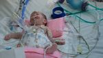 Haru, Kondisi Bayi Kembar Siam asal Palestina yang Akhirnya Terpisah
