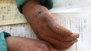 Menurut Kepala Sekolah, Wang selain tangguh juga pintar, khususnya di bidang matematika. Bocah bermuka lucu ini mendapat nilai hampir sempurna di mata pelajaran yang sulit itu. Foto: Peoples Daily