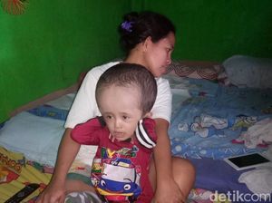 Kisah Rahman, Bocah Penderita Hidrosefalus asal Rancaekek Bandung