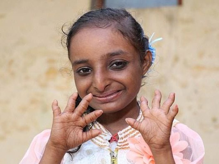 Dijuluki Gadis Tikus, Tinggi Gadis 18 Tahun Ini Cuma 84 Cm