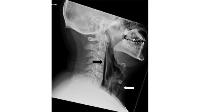 Kisah Pria Tahan Bersin Berujung Tenggorokan Pecah, Ini Awal Mulanya