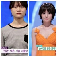 Setelah melahirkan anaknya pada usia 18 tahun, Lee Ji Won didiagnosis mengidap mastitis atau infeksi pada payudara. Ji Won pun kemudian ikut acara Let Me In untuk merekonstruksi atau memperbaiki payudara dan juga bagian rahang wajahnya. Foto: Istimewa