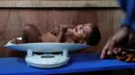 Potret Anak-anak Rohingya yang Menderita Gizi Buruk