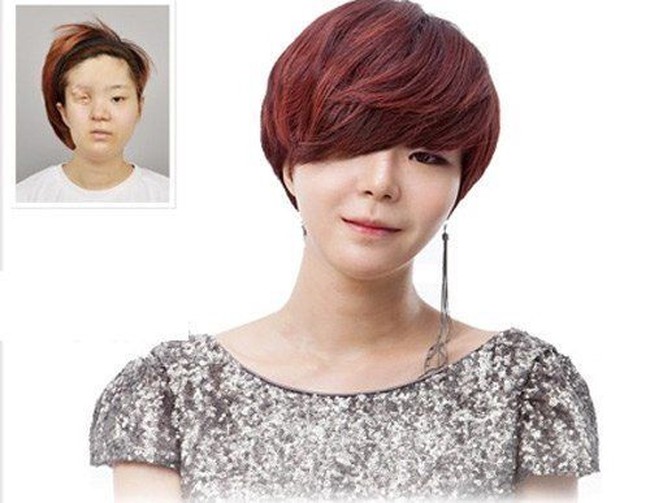 Pyo Ga Hee dijuluki sebagai Gadis Setengah Wajah. Ga Hee didiagnosis retinoblastoma sejak kecil dan harus menjalani perawatan kemoterapi ekstensif yang mempengaruhi pertumbuhan kulit di wajah, hal itu menyebabkan mata dan mulutnya tidak berkembang. Bagaimana penampilan Ga Hee setelah rekonstruksi wajah?Foto: Istimewa