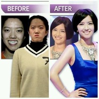 Rahang Choi Ji Hae terdistorsi dan 2cm lebih besar dibanding rahang normal. Hal ini tidak hanya menyebabkan wajahnya terlihat sedikit cacat tapi juga menyebabkan rasa sakit dalam kehidupan sehari-hari, terutama saat dia mencoba mengunyah makanan. Dia bahkan tidak bisa membayangkan untuk menjalani operasi plastik karena situasi keuangan yang sangat memprihatinkan dan ibunya yang sakit. Tapi, setelah berhasil menjadi kontestan di Let Me In, Ji Hae kini tampil menakjubkan. Foto: Istimewa