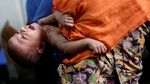 Potret Anak-anak Rohingya yang Menderita Gizi Buruk