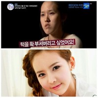 Ketika mengikuti acara tersebut, Shim Yu Ra merupakan gadis muda berusia 24 tahun yang memohon dan menangis agar wajahnya di operasi plastik. Ia mengaku telah diejek karena bentuk rahangnya yang aneh dan disebut-sebut sebagai ugly Korean. Foto: Istimewa