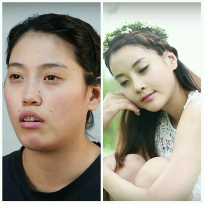 Park Dong Hee dijuluki raksasa karena ia memiliki tubuh jauh lebih besar dari rata-rata wanita Korea, Beberapa orang bahkan mengatakan kepadanya bahwa wajah Dong Hee terlihat seperti pemain sepak bola Ronaldino. Setelah menjalani bedah plastik, Dong Hee tampil lebih ramping dan cantik. Foto: Istimewa