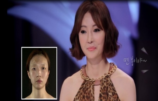 Choi Sun Mi mengalami kecelakaan tragis saat berada di taman kanak-kanak saat ia dalam perjalanan pulang sekolah. Hal tersebut pun membuat sebagian kulit wajahnya hancur. Setelah menjalani beberapa prosedur rekonstruksi wajah terutama pada bagian alis dan matanya, Sun Mi pun kini tampil percaya diri dan menarik Foto: Istimewa