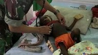 Menurut laporan pihak gereja dari Asmat 61 orang anak meninggal akibat penyakit gizi buruk dan campak. Kejadian luar biasa terakhir atas kasus serupa pada 2011 lalu. Muhhamad Aidi/AFP.