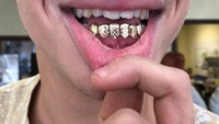 Bahkan orang zaman dahulu pun juga banyak yang menggunakan gigi emas atau grill ini. Foto: Instagram