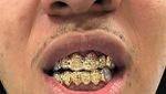Foto Orang-orang dengan Gigi Emas Terunik, Mau Lihat?