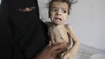 Foto Mirisnya Anak-anak Gizi Buruk di Berbagai Belahan Dunia