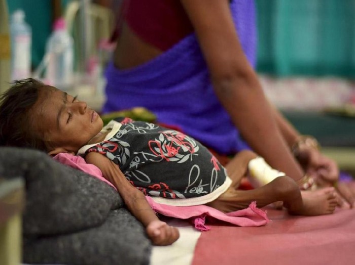 41+ Gambar Anak Kecil Kurang Gizi Gratis Terbaik