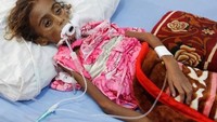Perang membuat seorang gadis berusia 7 tahun di Yaman terserang malnutrisi parah. (Reuters/Abduljabbar Zeyad)