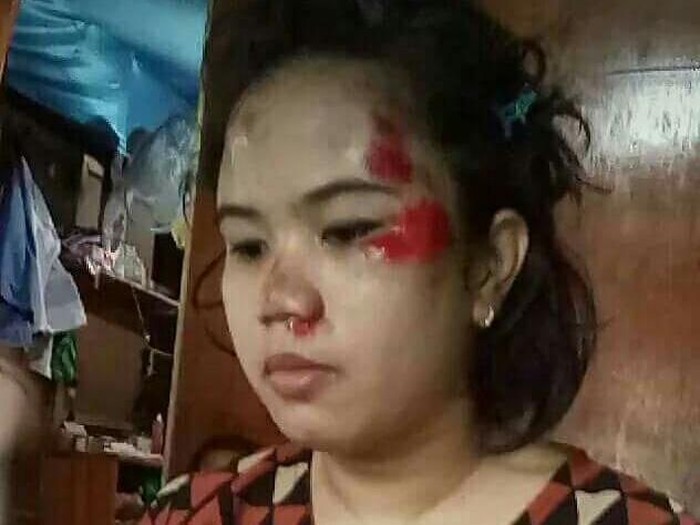 Melawan Begal dan Tersungkur, Mahasiswi Suciwati Trauma
