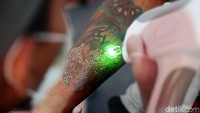 Tato-tato ini dihapus dengan sinar laser.