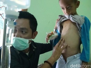 Alami Gizi Buruk, Bocah 9 Tahun di Babel Hanya Berbobot 15 Kg