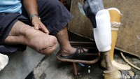 Beberapa dari mereka diamputasi bukan hanya karena kusta, melainkan karena didiagnosis kanker tulang atau kanker kulit. Foto: Rachman Haryanto