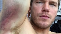 Chris memamerkan luka memar yang ia alami saat sedang shooting film. (Foto: Instagram/prattprattpratt)