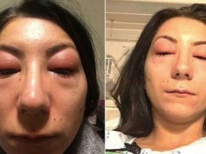 Ekstensi Bulu Mata, Wanita Ini Kena Reaksi Alergi Parah