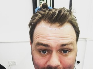 Mulai Botak, Brian McFadden Eks Westlife Lakukan Transplantasi Rambut