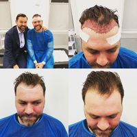 Mulai Botak, Brian McFadden Eks Westlife Lakukan Transplantasi Rambut