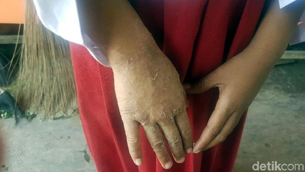 Salah seorang bocah di Sukabumi yang diduga terpapar merkuri. Dok: Kemenko Maritim