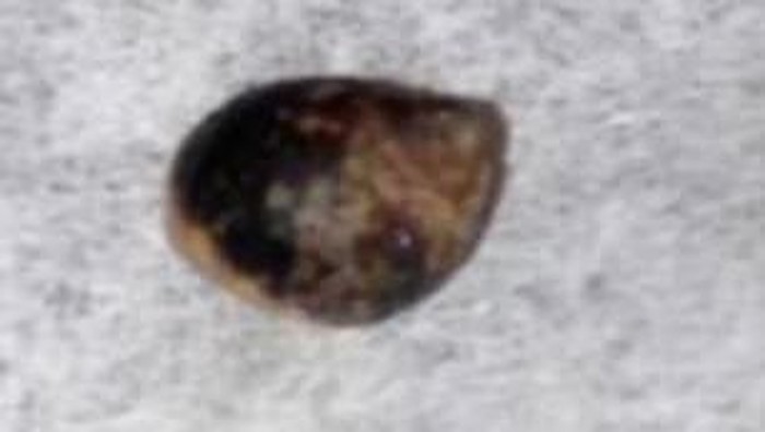 Hii! Dokter Angkat Siput Kerdil dari Benjolan di Tubuh Bocah 11 Tahun