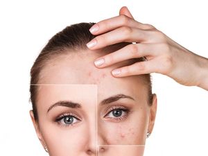 11 Cara Hilangkan Jerawat Batu dengan Alami dan Mudah