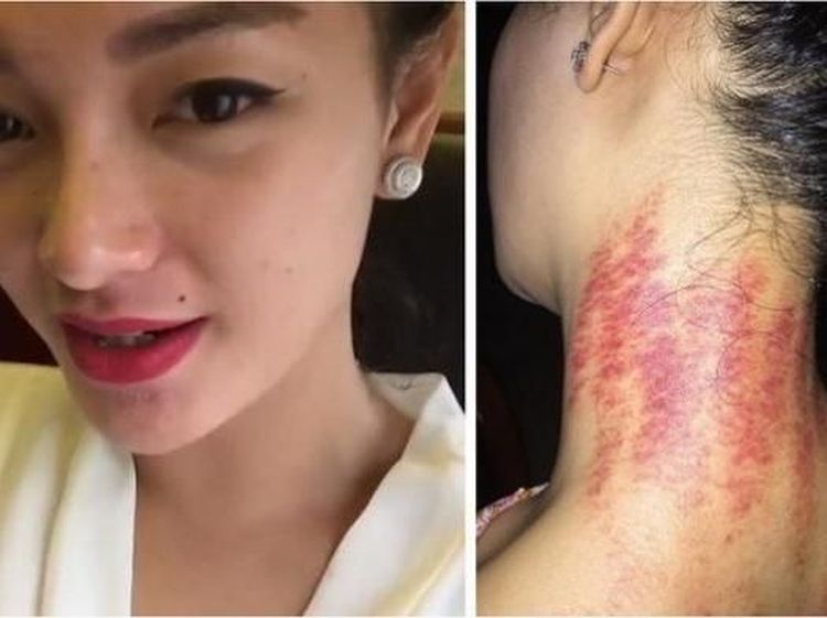 Dari Deddy Corbuzier Hingga Zaskia Gotik, Sederet Artis yang Gemar Kerokan