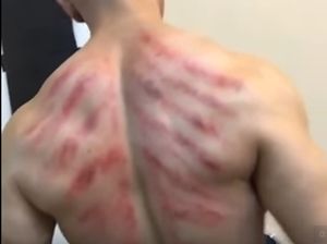 Masuk Angin? Jangan Suka Dikerok!