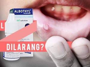 Albothyl Dilarang, Ini Saran PDGI untuk Obati Sariawan