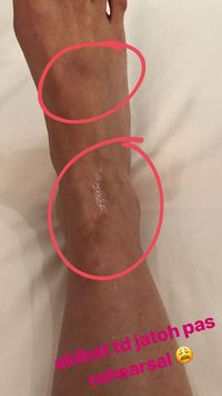 Luka di kaki Bunga Citra Lestari