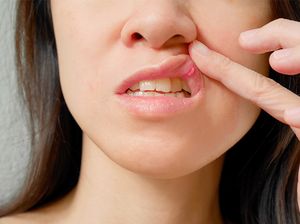 Ini Cara Membedakan Sariawan Biasa dengan Gejala COVID-19