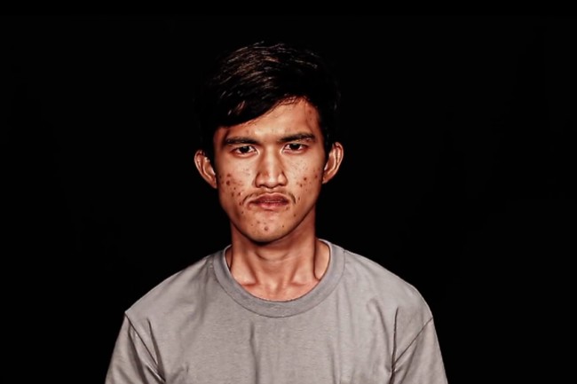 Pria bernama Noppajit Monlin ini adalah seorang buruh pabrik di Thailand. Ia sangat tidak percaya diri akan penampilannya dan merasa malu dengan wajahnya yang dipenuhi bekas jerawat. Foto: dok. Let Me In