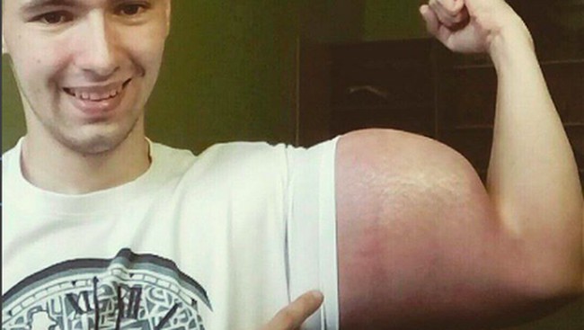 Risiko komplikasinya kasus ini sangat tinggi tapi jika lamban dilakukan tidak akan menolong pasien. Zat beracun jangka panjang dalam tubuh dapat mempersulit kerja ginjal dan menyebabkan kematian, tuturnya.Foto: Instagram