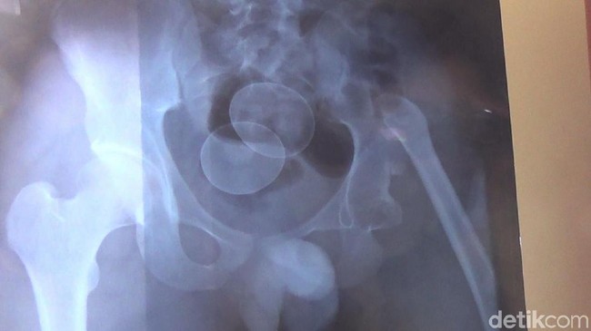 Februari: KLB Gizi Buruk di Asmat, Remaja Bertelur di Gowa