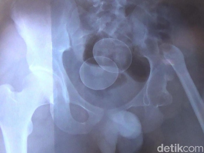 Hasil rontgen menunjukkan ada dua butir telur dalam tubuh Akmal. (Foto: Yahya Maulana/detikcom) Hasil rontgen menunjukkan ada dua butir telur dalam tubuh Akmal. (Foto: Yahya Maulana/detikcom)