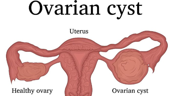 Tiap wanita memiliki dua ovarium yang berfungsi memproduksi sel telur dan mengeluarkan hormon. Kista juga bisa timbul di daerah ini. Foto: Thinkstock Tiap wanita memiliki dua ovarium yang berfungsi memproduksi sel telur dan mengeluarkan hormon. Kista juga bisa timbul di daerah ini. Foto: Thinkstock